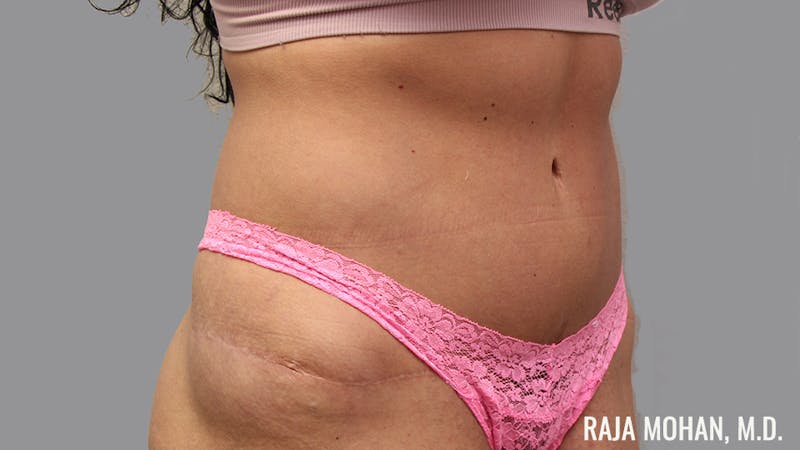 Tummy Tuck Before & After Gallery - Patient 376337 - Image 4