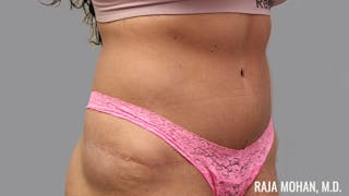 Tummy Tuck Before & After Gallery - Patient 376337 - Image 4