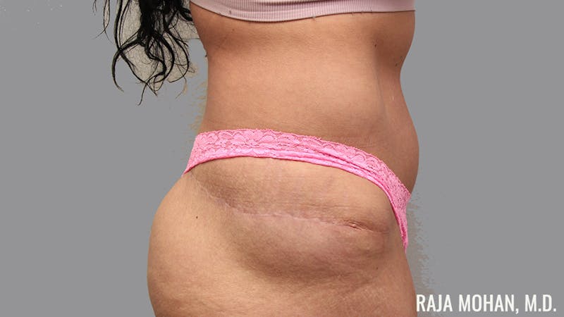 Tummy Tuck Before & After Gallery - Patient 376337 - Image 6