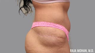 Tummy Tuck Before & After Gallery - Patient 376337 - Image 6