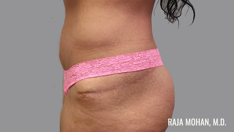 Tummy Tuck Before & After Gallery - Patient 376337 - Image 8