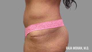 Tummy Tuck Before & After Gallery - Patient 376337 - Image 8
