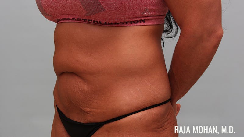 Tummy Tuck Before & After Gallery - Patient 376337 - Image 9