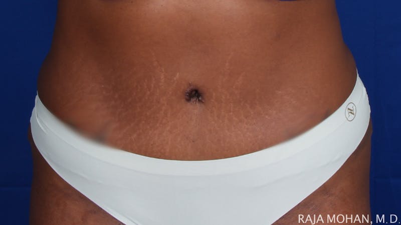 Tummy Tuck Before & After Gallery - Patient 193714 - Image 2