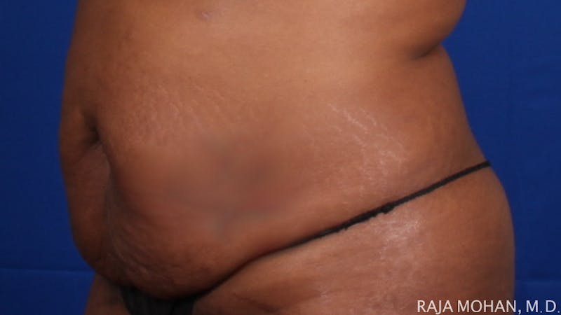 Tummy Tuck Before & After Gallery - Patient 193714 - Image 5