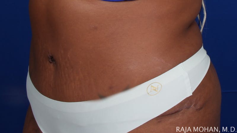 Tummy Tuck Before & After Gallery - Patient 193714 - Image 6