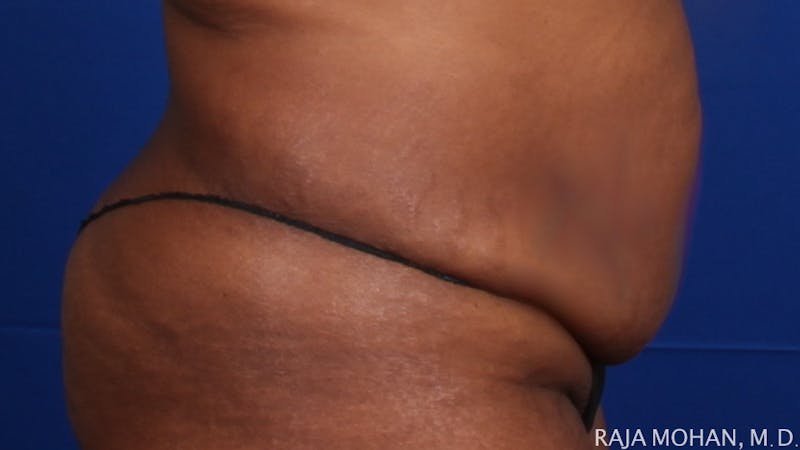 Tummy Tuck Before & After Gallery - Patient 193714 - Image 7