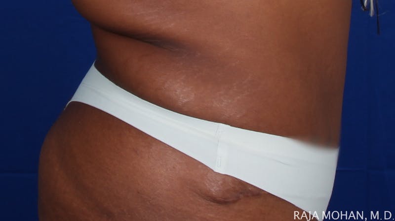 Tummy Tuck Before & After Gallery - Patient 193714 - Image 8