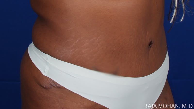 Tummy Tuck Before & After Gallery - Patient 193714 - Image 10