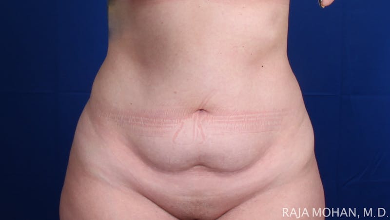 Tummy Tuck Before & After Gallery - Patient 129825 - Image 1