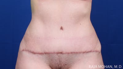 Tummy Tuck Before & After Gallery - Patient 129825 - Image 2