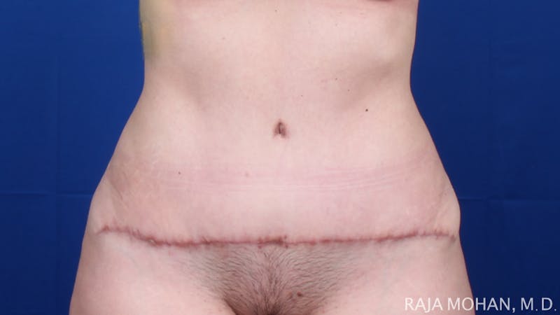 Tummy Tuck Before & After Gallery - Patient 129825 - Image 2