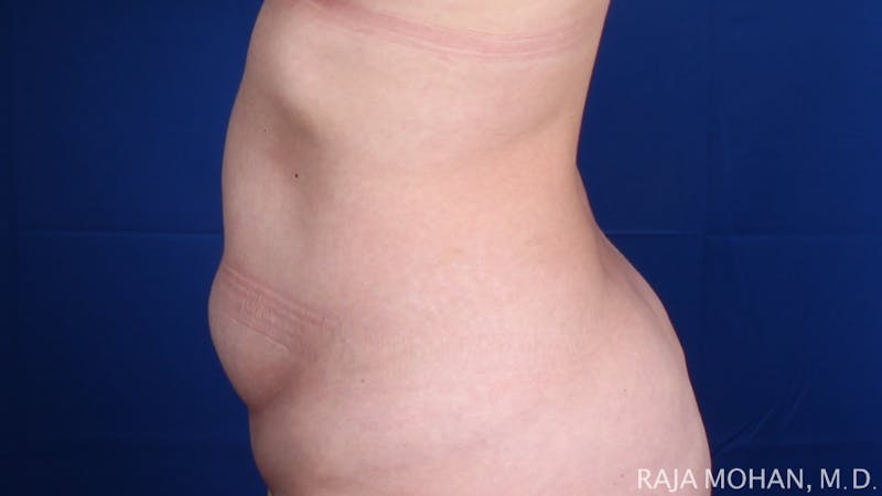 Tummy Tuck Before & After Gallery - Patient 129825 - Image 3