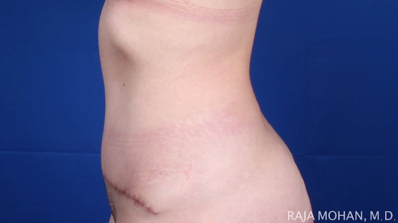 Tummy Tuck Before & After Gallery - Patient 129825 - Image 4