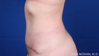 Tummy Tuck Before & After Gallery - Patient 129825 - Image 4