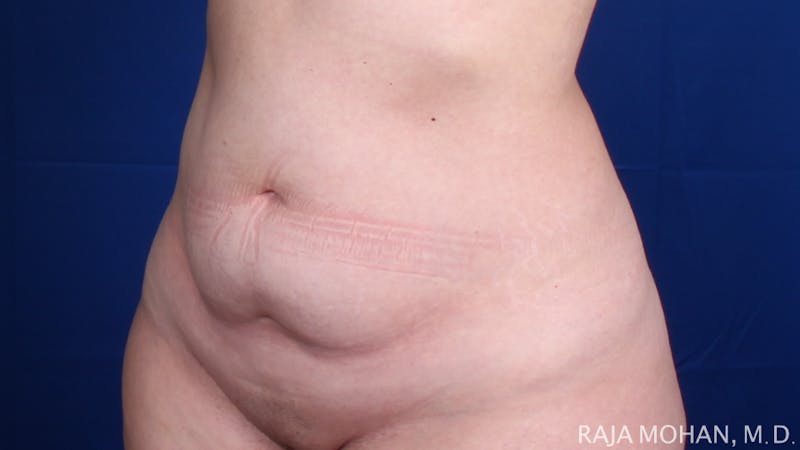 Tummy Tuck Before & After Gallery - Patient 129825 - Image 5