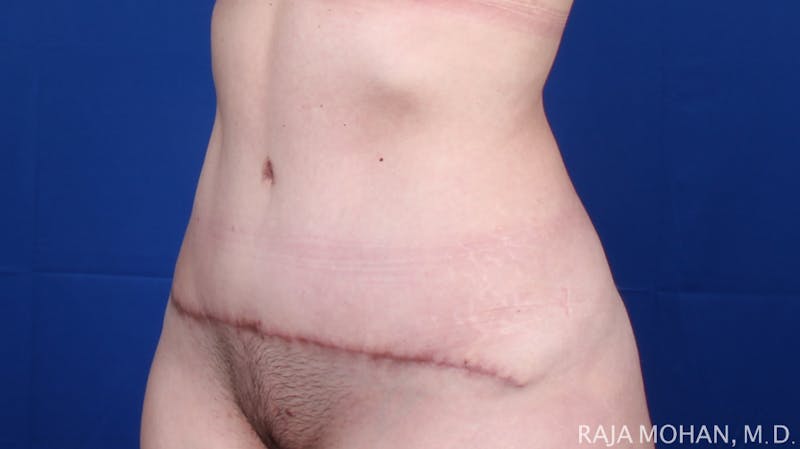 Tummy Tuck Before & After Gallery - Patient 129825 - Image 6