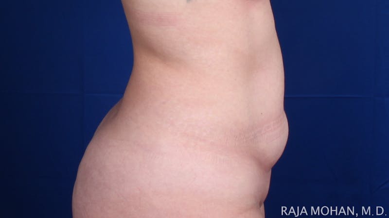 Tummy Tuck Before & After Gallery - Patient 129825 - Image 7