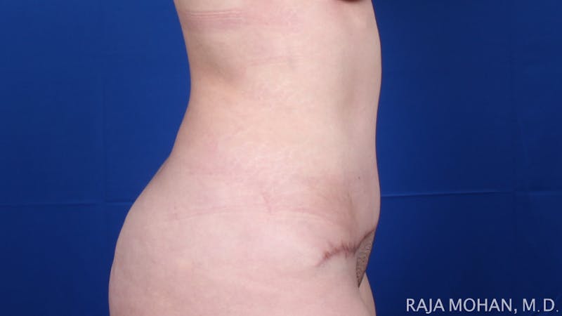 Tummy Tuck Before & After Gallery - Patient 129825 - Image 8