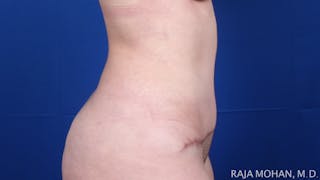 Tummy Tuck Before & After Gallery - Patient 129825 - Image 8