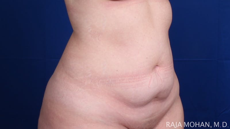 Tummy Tuck Before & After Gallery - Patient 129825 - Image 9