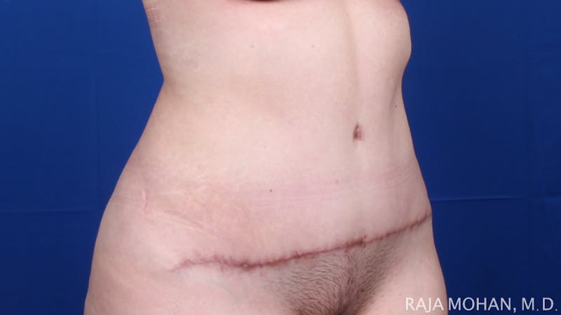 Tummy Tuck Before & After Gallery - Patient 129825 - Image 10