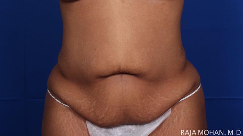Tummy Tuck Before & After Gallery - Patient 428819 - Image 1