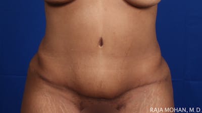 Tummy Tuck Before & After Gallery - Patient 428819 - Image 2