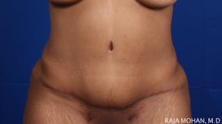 Tummy Tuck Before & After Gallery - Patient 428819 - Image 2