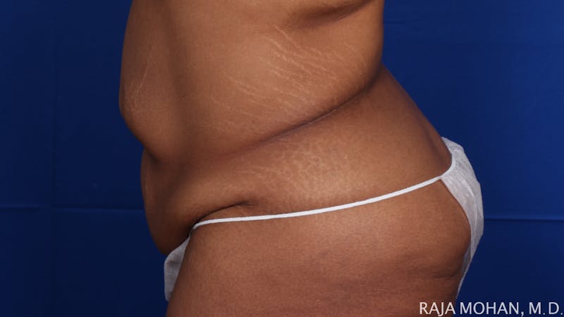 Tummy Tuck Before & After Gallery - Patient 428819 - Image 3