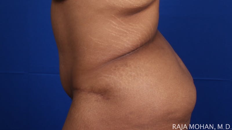 Tummy Tuck Before & After Gallery - Patient 428819 - Image 4
