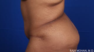 Tummy Tuck Before & After Gallery - Patient 428819 - Image 4