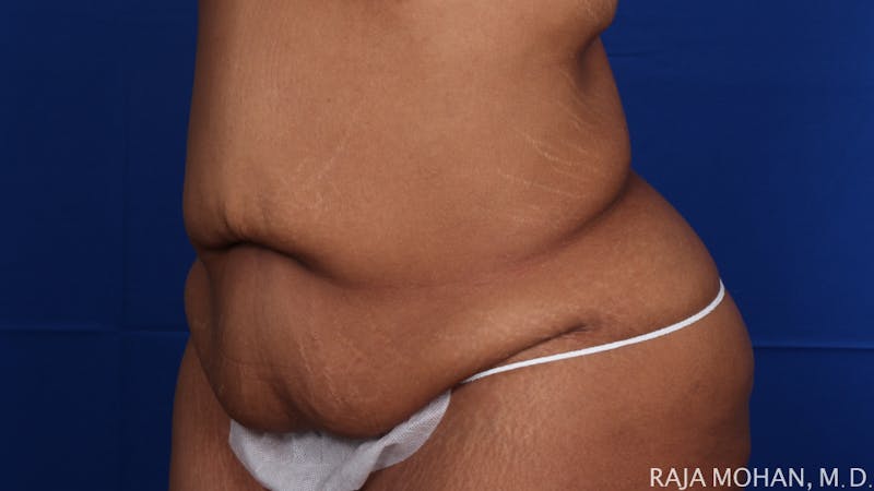 Tummy Tuck Before & After Gallery - Patient 428819 - Image 5