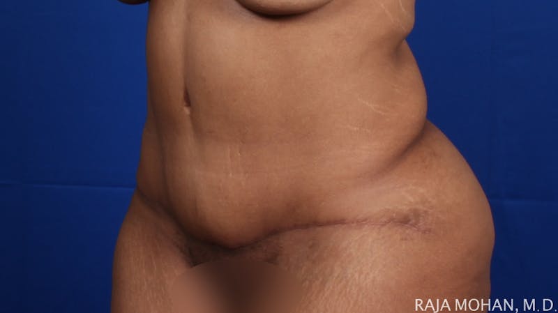 Tummy Tuck Before & After Gallery - Patient 428819 - Image 6