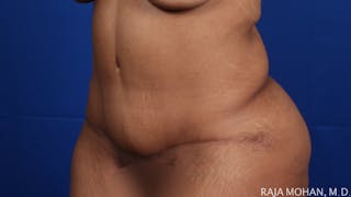 Tummy Tuck Before & After Gallery - Patient 428819 - Image 6