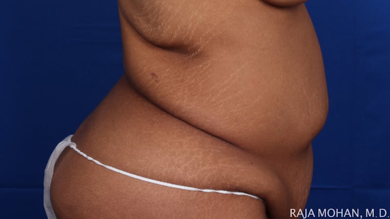 Tummy Tuck Before & After Gallery - Patient 428819 - Image 7