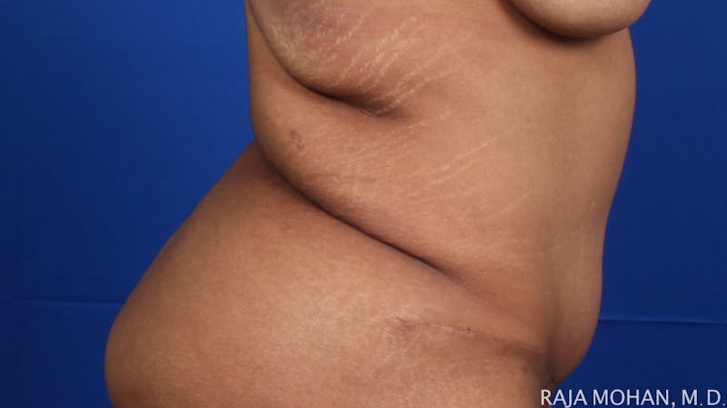Tummy Tuck Before & After Gallery - Patient 428819 - Image 8