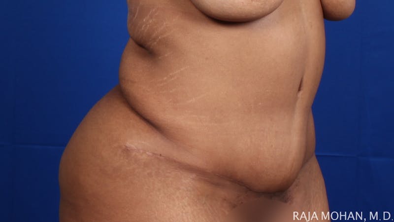 Tummy Tuck Before & After Gallery - Patient 428819 - Image 10