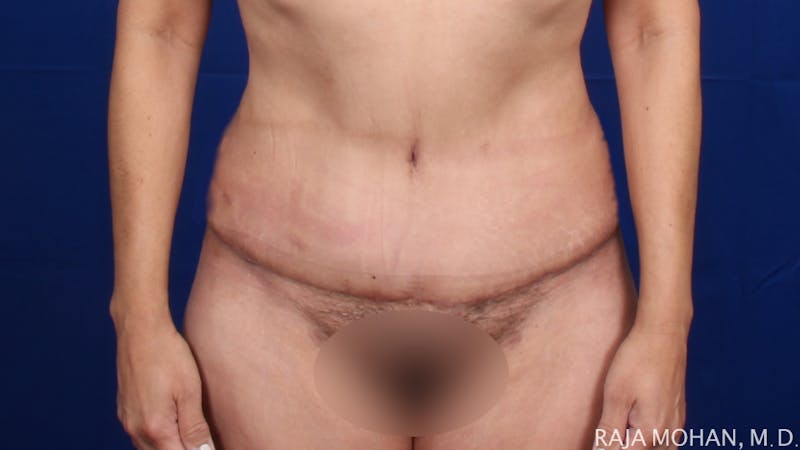 Tummy Tuck Before & After Gallery - Patient 261467 - Image 2