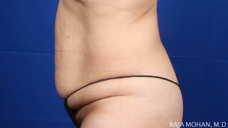 Tummy Tuck Before & After Gallery - Patient 261467 - Image 3