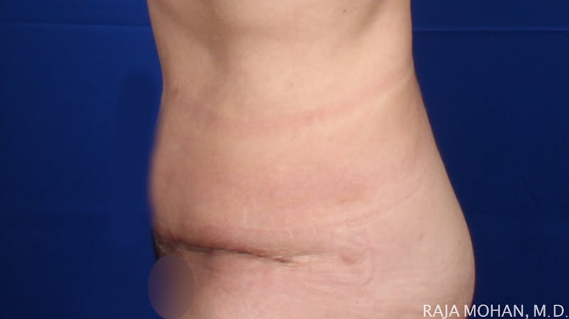 Tummy Tuck Before & After Gallery - Patient 261467 - Image 4