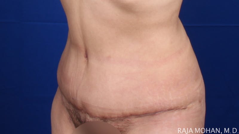 Tummy Tuck Before & After Gallery - Patient 261467 - Image 6