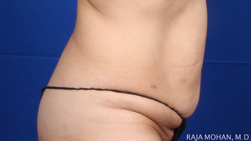 Tummy Tuck Before & After Gallery - Patient 261467 - Image 7