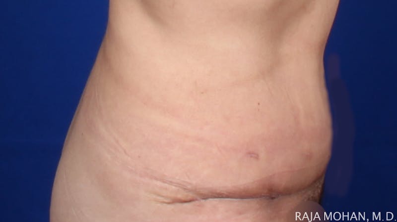 Tummy Tuck Before & After Gallery - Patient 261467 - Image 8