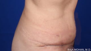 Tummy Tuck Before & After Gallery - Patient 261467 - Image 8