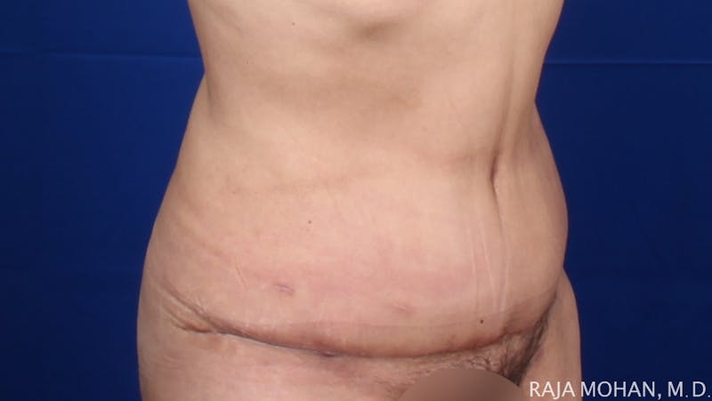 Tummy Tuck Before & After Gallery - Patient 261467 - Image 10