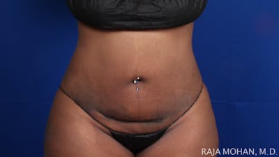 Tummy Tuck Before & After Gallery - Patient 354479 - Image 1