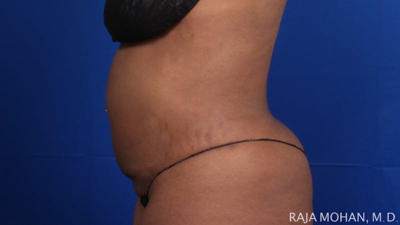 Tummy Tuck Before & After Gallery - Patient 354479 - Image 3