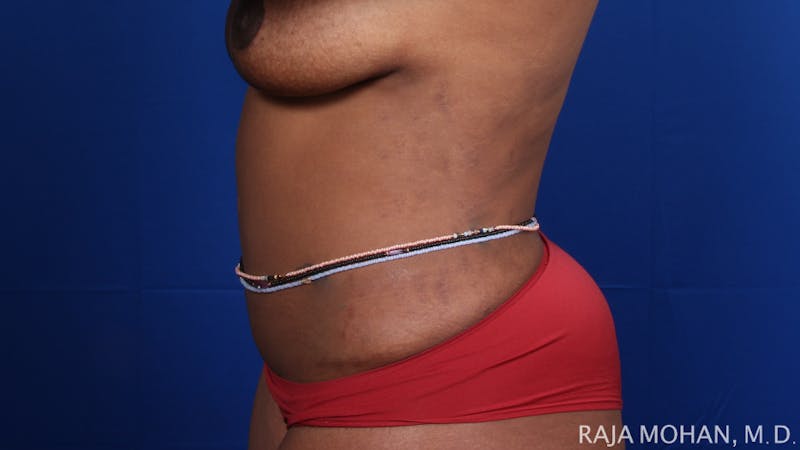 Tummy Tuck Before & After Gallery - Patient 354479 - Image 4