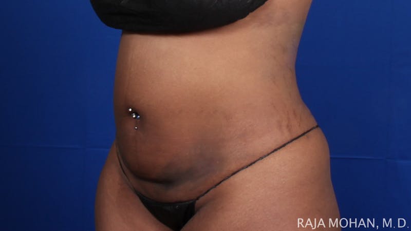 Tummy Tuck Before & After Gallery - Patient 354479 - Image 5
